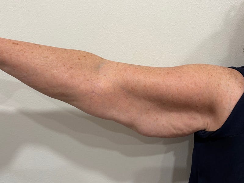 Everesse Before & After Gallery - Patient 226404 - Image 4