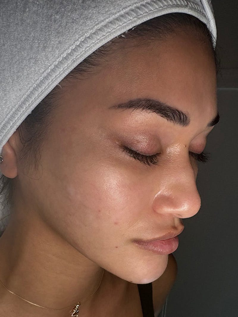 AquaFirme XS Before & After Gallery - Patient 392264 - Image 3