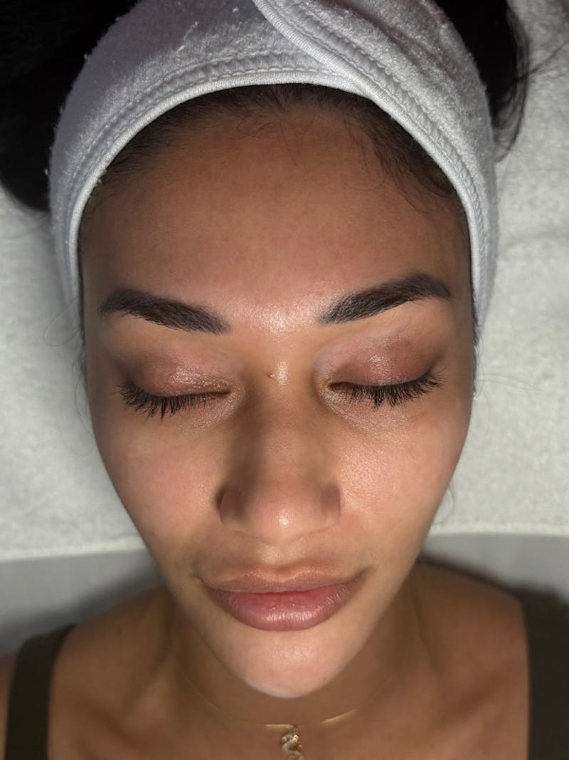 AquaFirme XS Before & After Gallery - Patient 392264 - Image 1