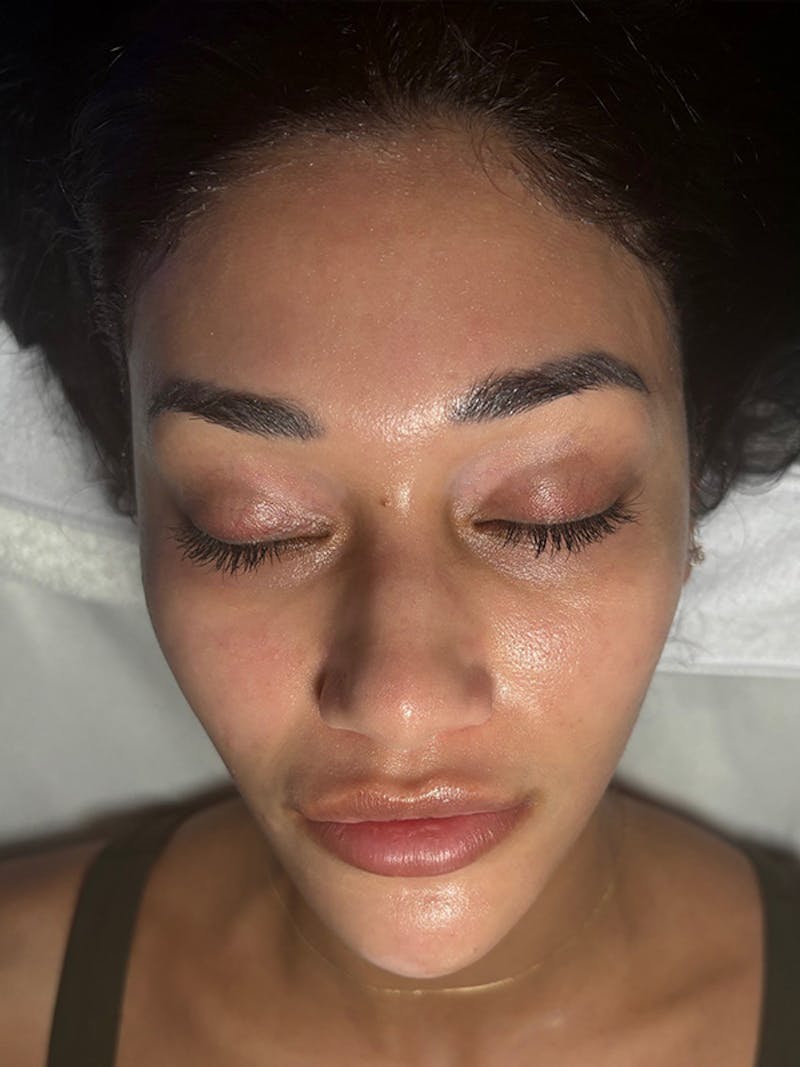 AquaFirme XS Before & After Gallery - Patient 392264 - Image 2