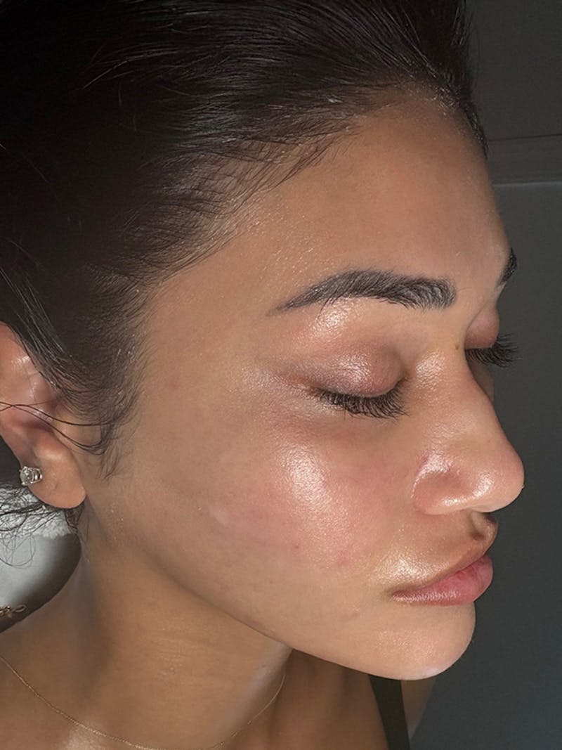 AquaFirme XS Before & After Gallery - Patient 392264 - Image 4