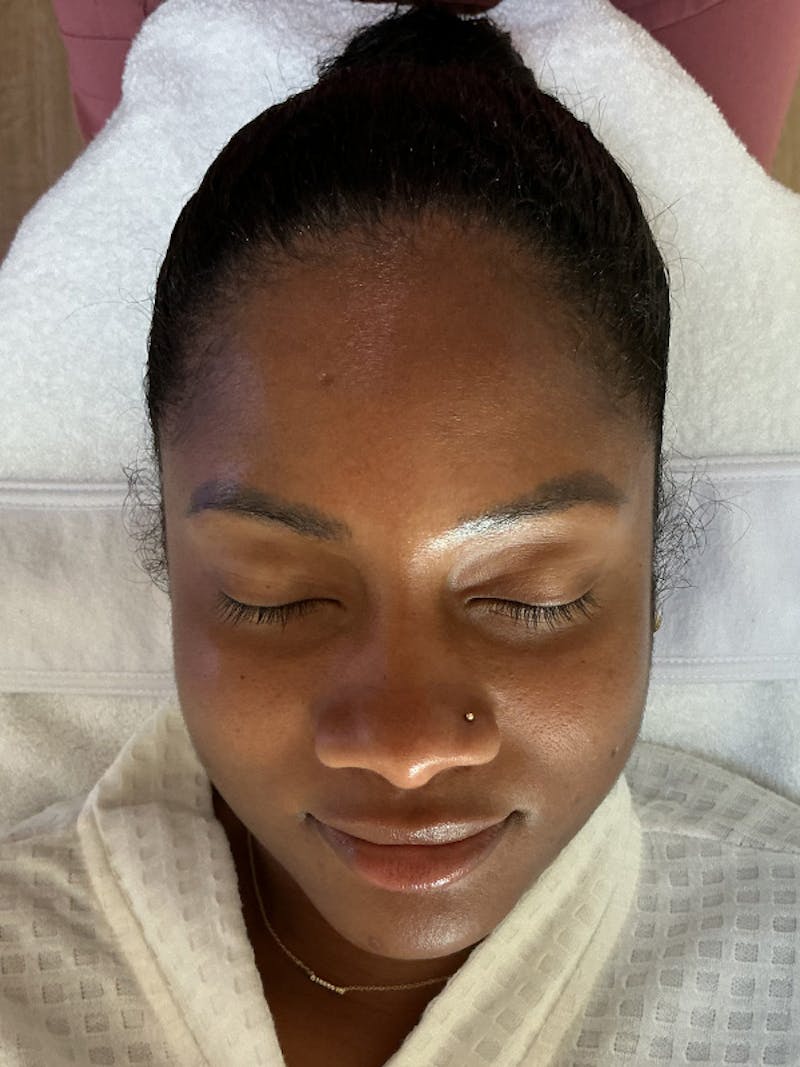 AquaFirme XS Before & After Gallery - Patient 396887 - Image 1