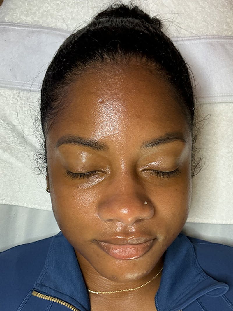 AquaFirme XS Before & After Gallery - Patient 396887 - Image 2