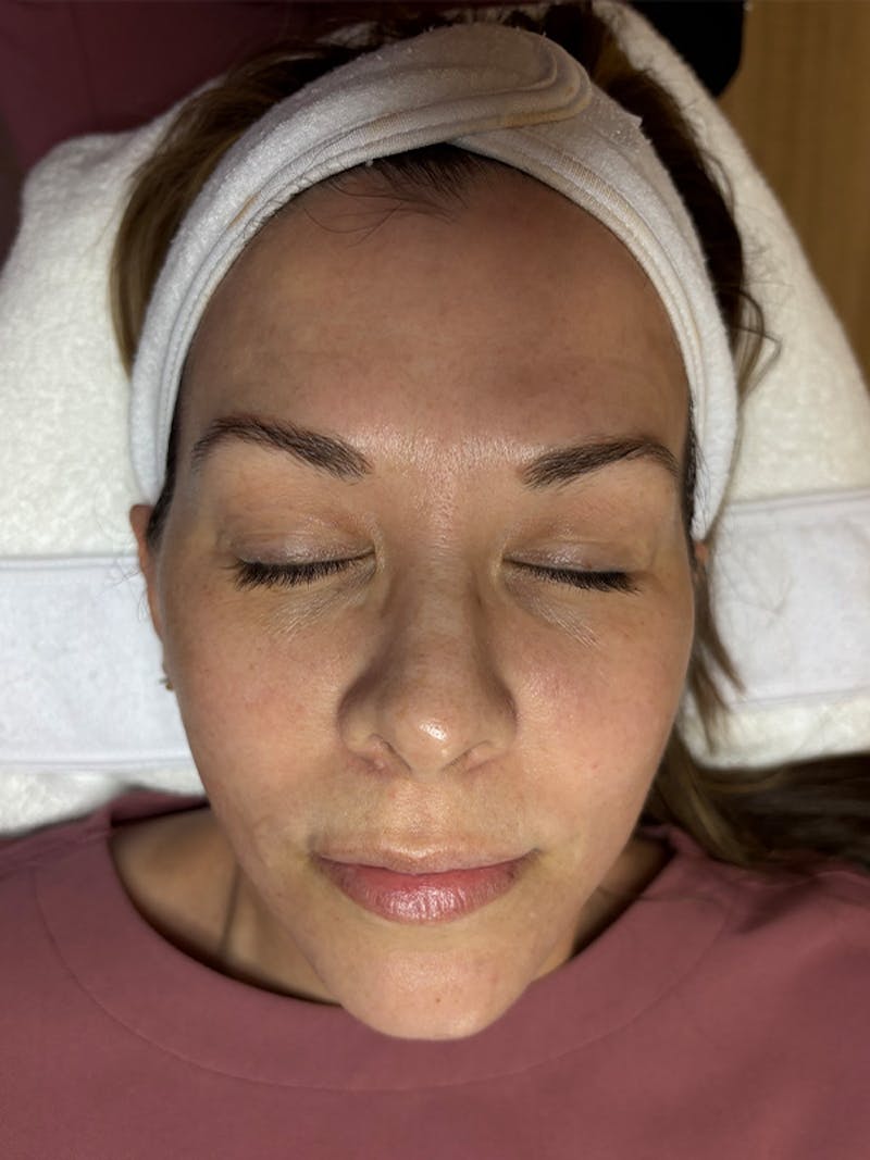 AquaFirme XS Before & After Gallery - Patient 172817 - Image 1