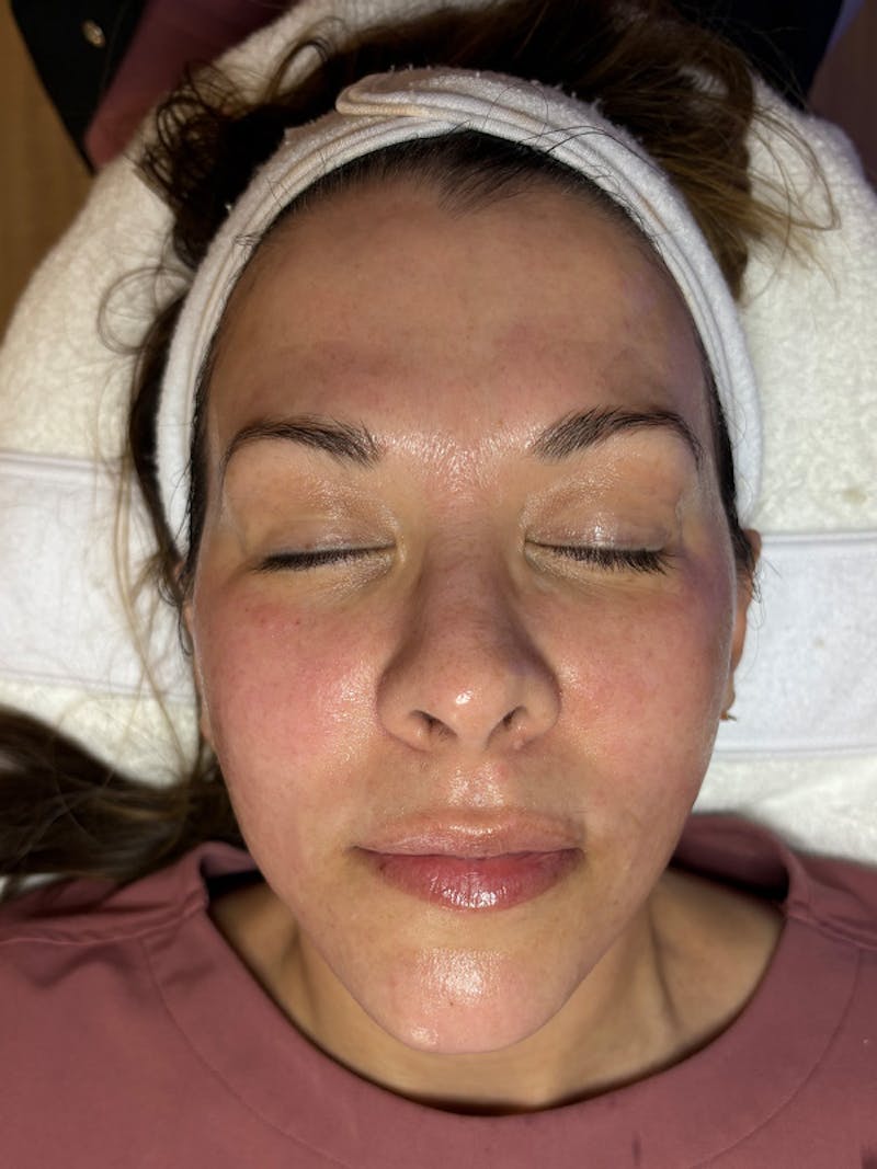 AquaFirme XS Before & After Gallery - Patient 172817 - Image 2