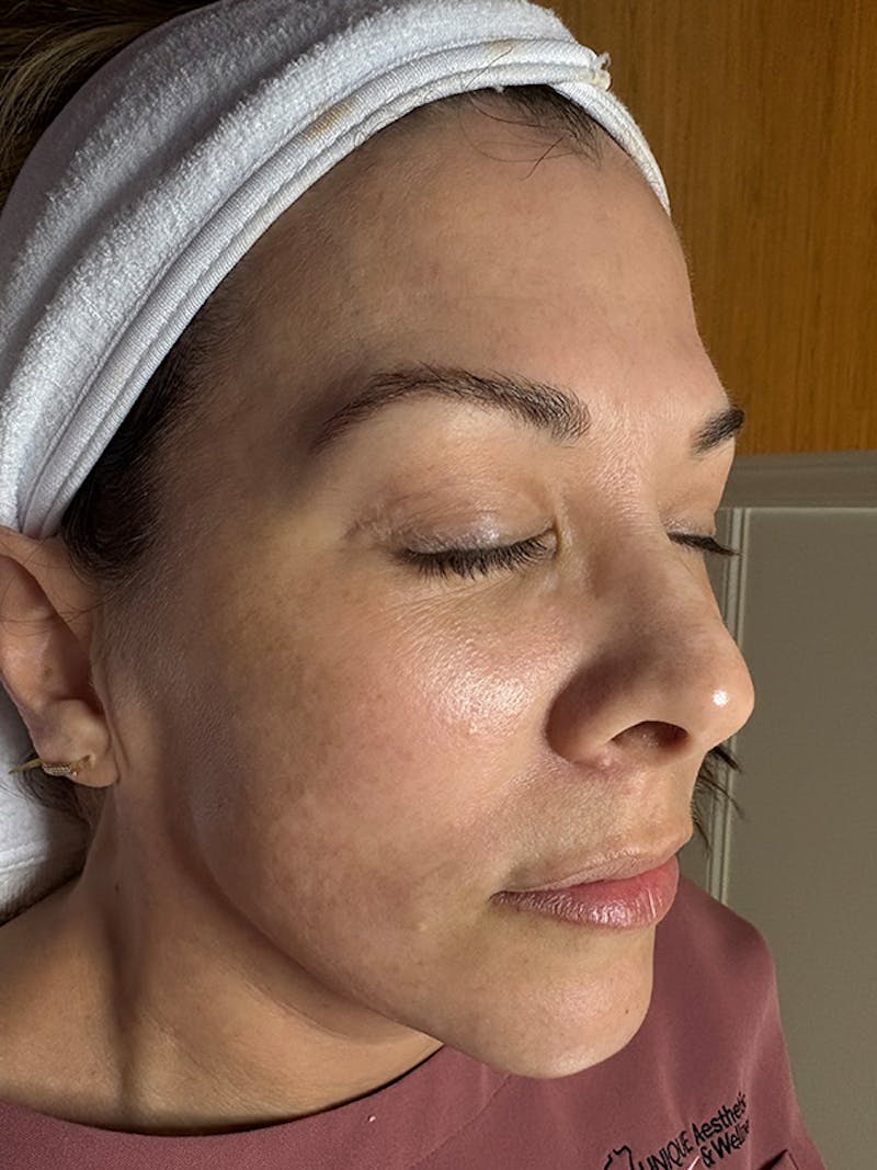 AquaFirme XS Before & After Gallery - Patient 172817 - Image 3