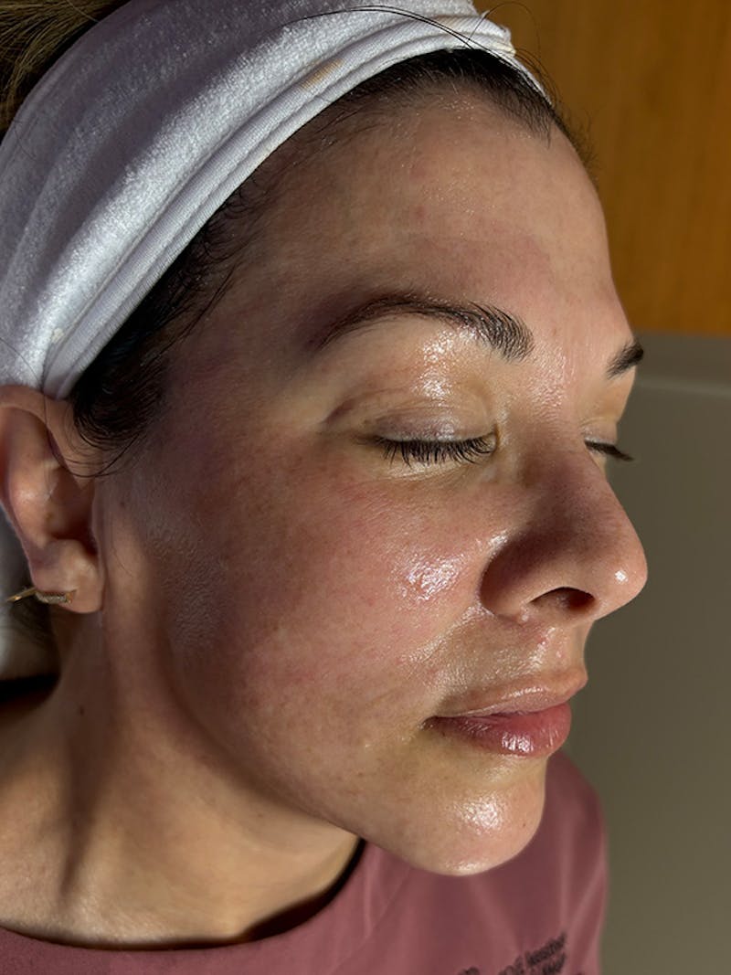 AquaFirme XS Before & After Gallery - Patient 172817 - Image 4