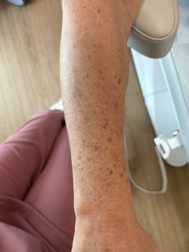 Motus AZ+ Laser Hair Removal Before & After Gallery - Patient 426809 - Image 1