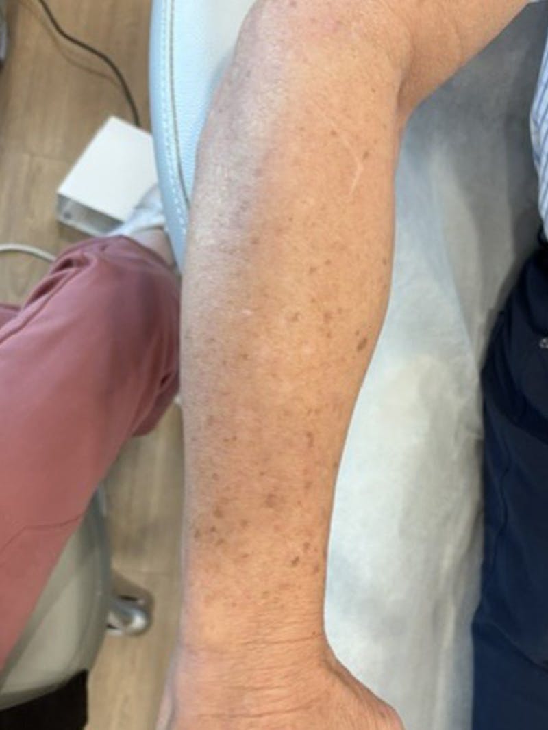 Motus AZ+ Laser Hair Removal Before & After Gallery - Patient 426809 - Image 2