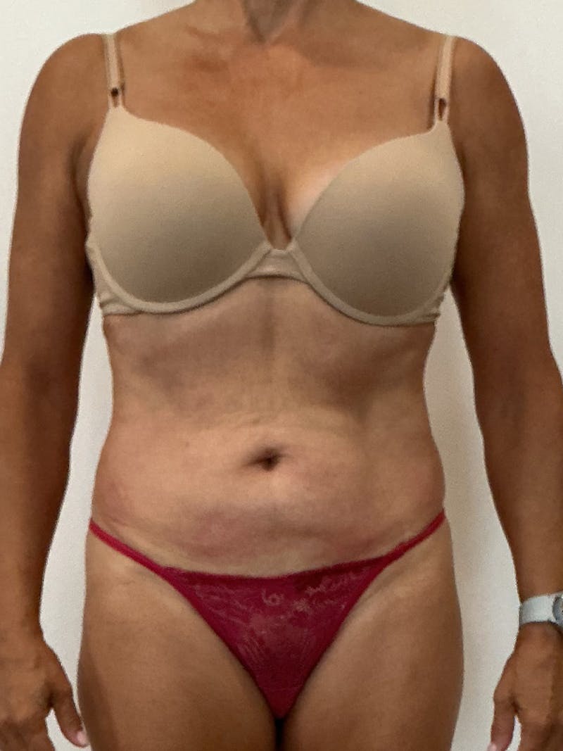 PHYSIQ 360 Before & After Gallery - Patient 145345 - Image 2