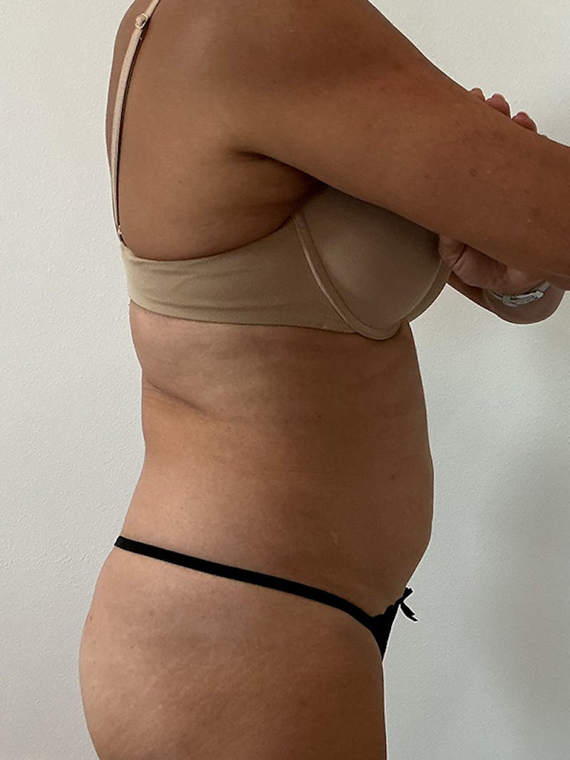 PHYSIQ 360 Before & After Gallery - Patient 145345 - Image 3