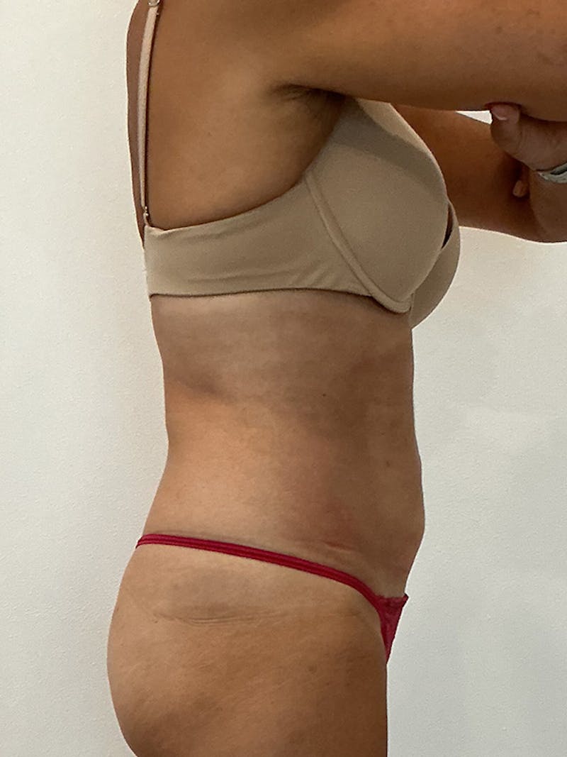 PHYSIQ 360 Before & After Gallery - Patient 145345 - Image 4