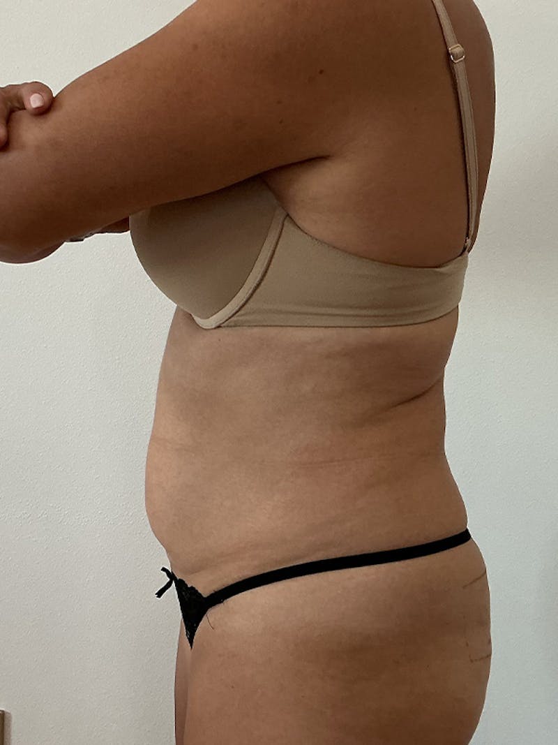 PHYSIQ 360 Before & After Gallery - Patient 145345 - Image 5