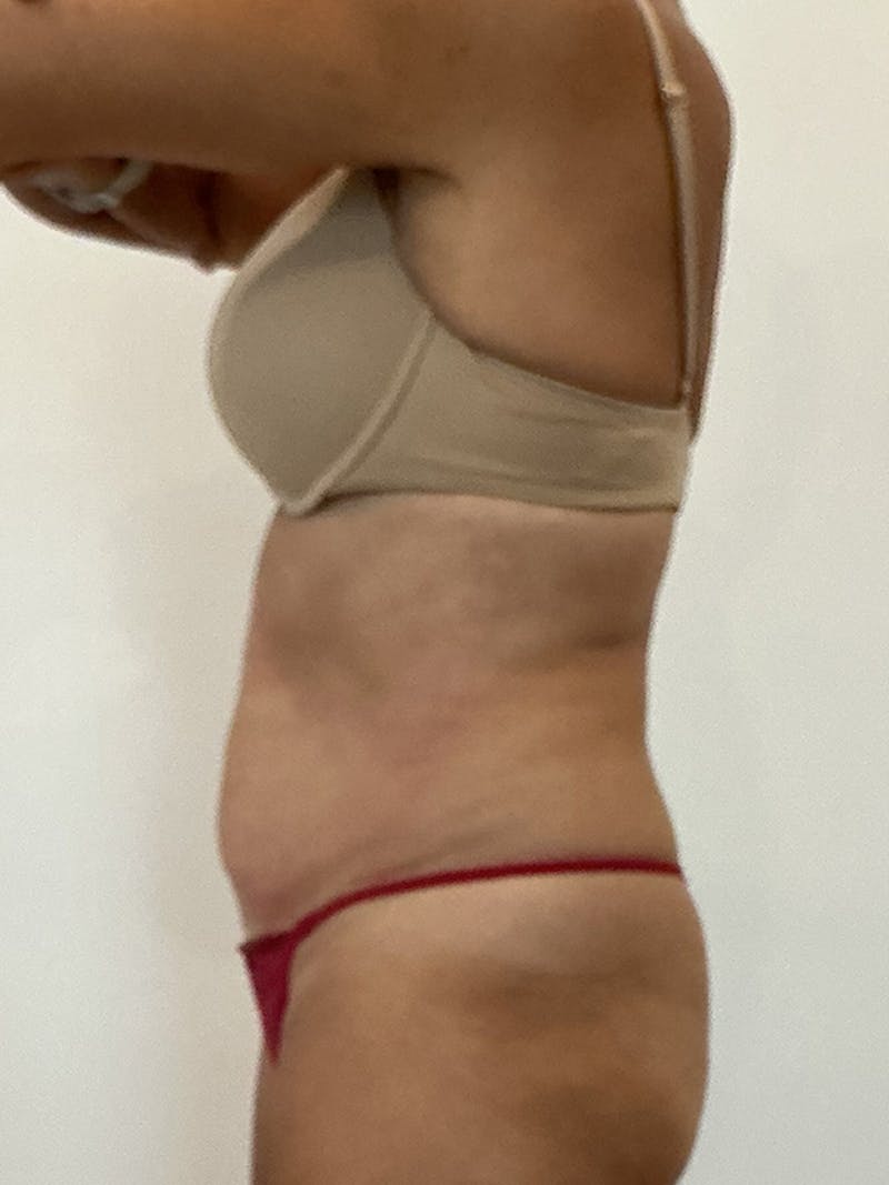 PHYSIQ 360 Before & After Gallery - Patient 145345 - Image 6