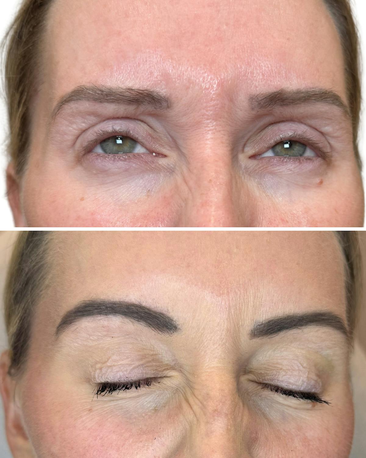 Tox Before & After Gallery - Patient 169267 - Image 1