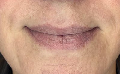 Lip Fillers Before & After Gallery - Patient 155312 - Image 1