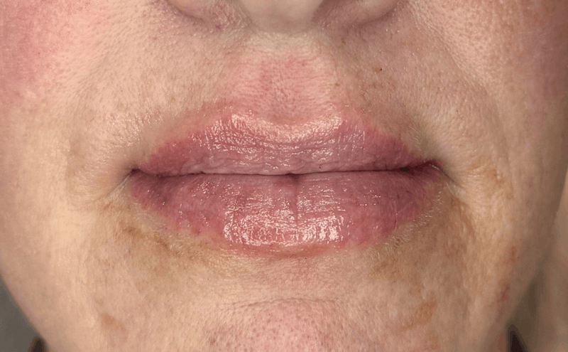 Lip Fillers Before & After Gallery - Patient 155312 - Image 2