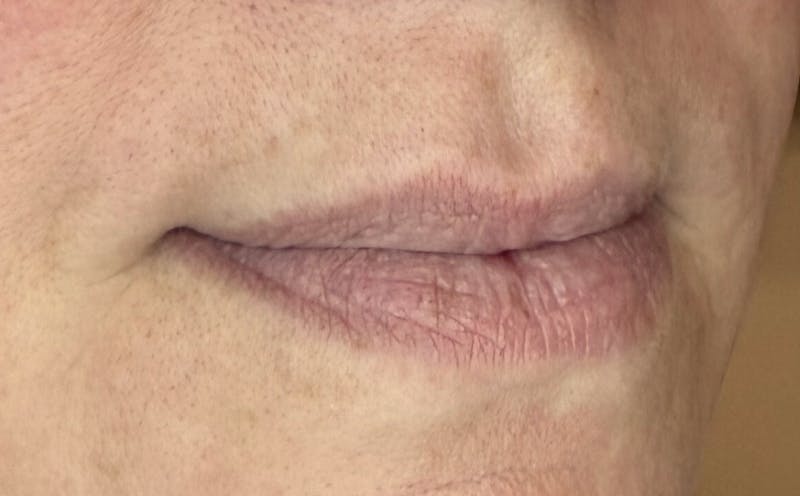 Lip Fillers Before & After Gallery - Patient 155312 - Image 3