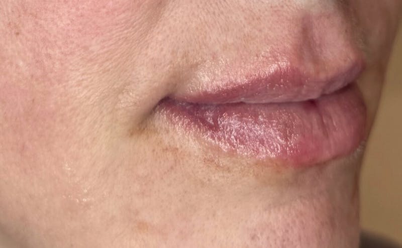 Lip Fillers Before & After Gallery - Patient 155312 - Image 4