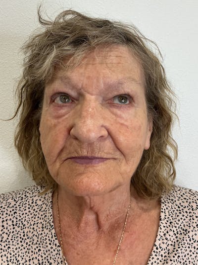 Tetra Before & After Gallery - Patient 350762 - Image 1