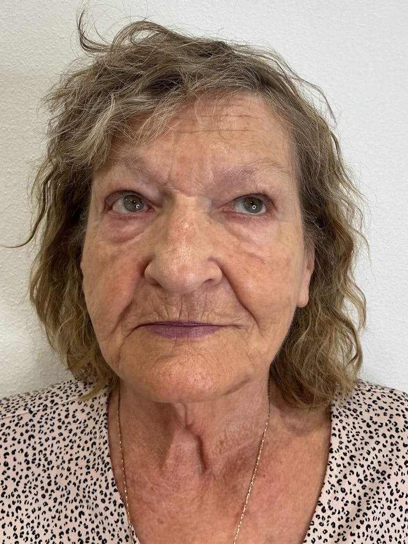 Tetra Before & After Gallery - Patient 350762 - Image 1