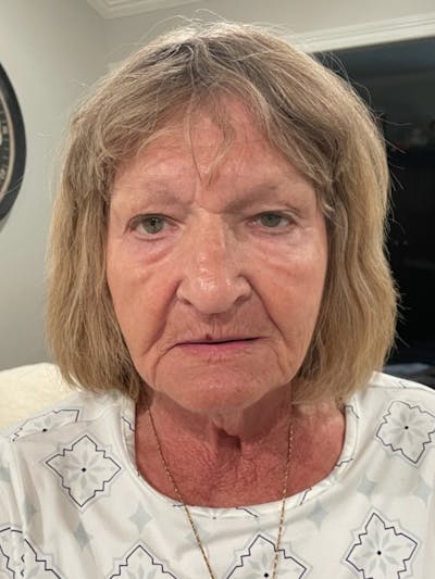 Tetra Before & After Gallery - Patient 350762 - Image 2