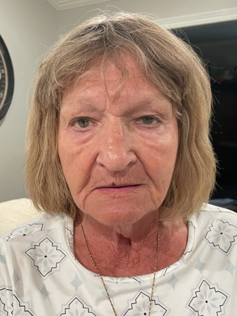 Tetra Before & After Gallery - Patient 350762 - Image 2