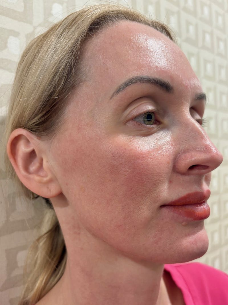 Tetra Before & After Gallery - Patient 424652 - Image 1