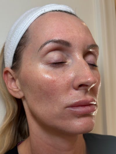 Tetra Before & After Gallery - Patient 424652 - Image 2