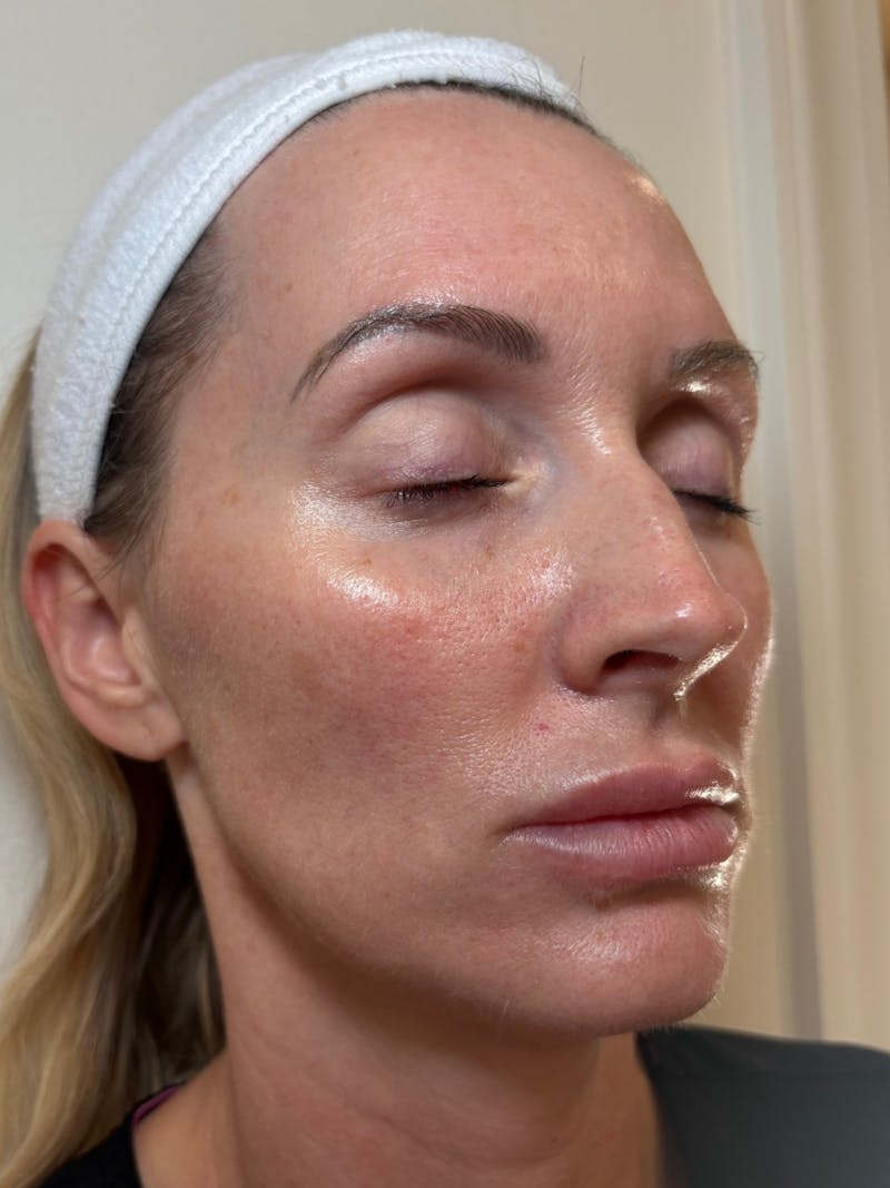 Tetra Before & After Gallery - Patient 424652 - Image 2