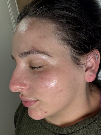 AquaFirme XS Before & After Gallery - Patient 266601 - Image 2