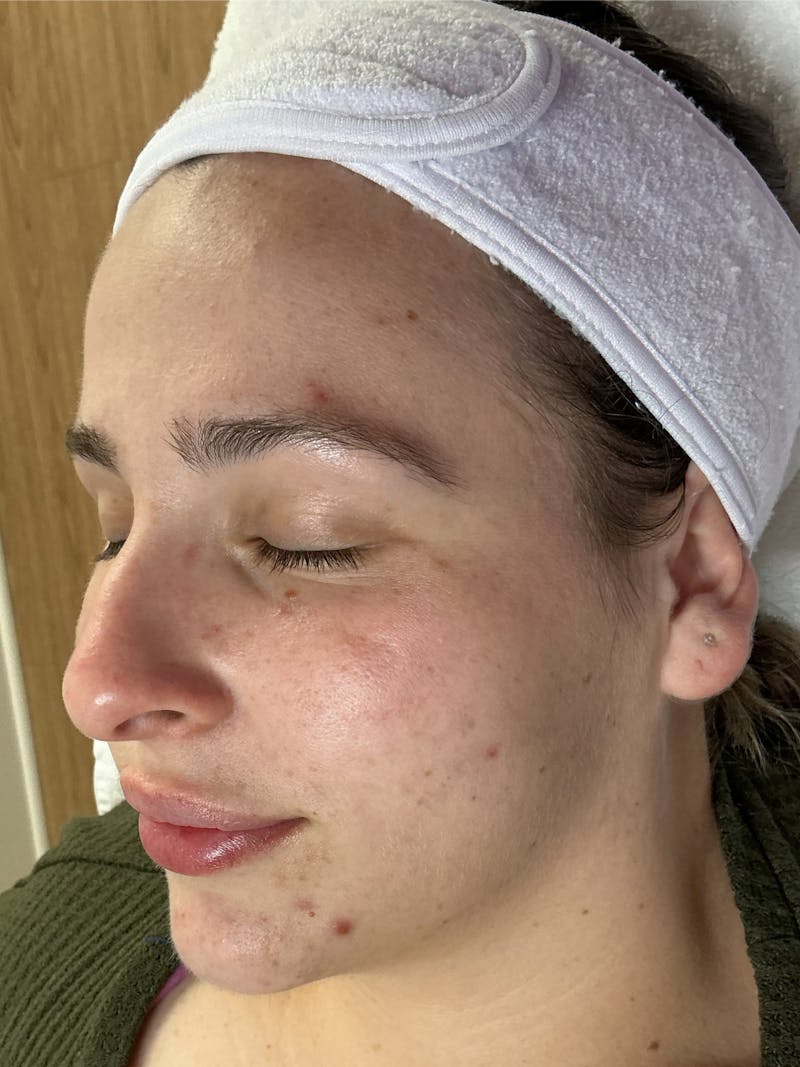 AquaFirme XS Before & After Gallery - Patient 266601 - Image 1