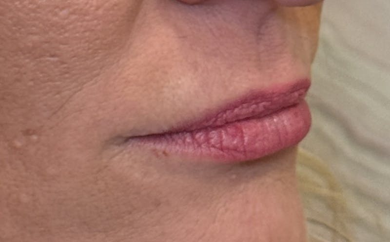 Lip Fillers Before & After Gallery - Patient 138222 - Image 5