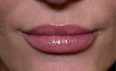 Lip Fillers Before & After Gallery - Patient 138222 - Image 2