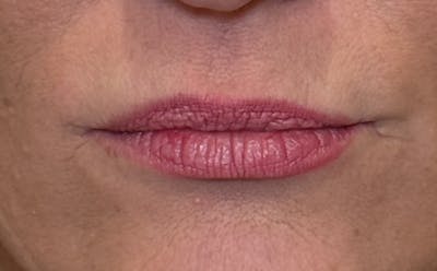 Lip Fillers Before & After Gallery - Patient 138222 - Image 1