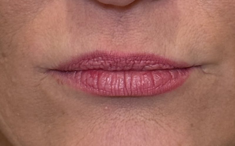 Lip Fillers Before & After Gallery - Patient 138222 - Image 1