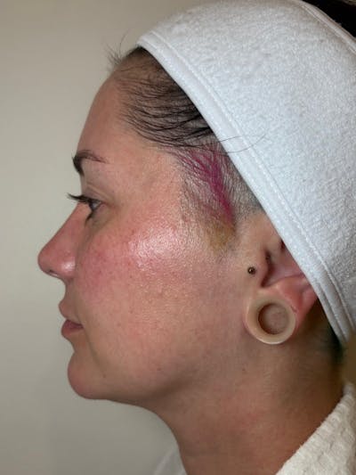 Everesse Before & After Gallery - Patient 485185 - Image 2