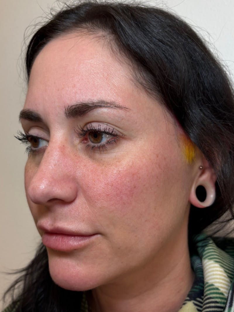 Everesse Before & After Gallery - Patient 485185 - Image 3