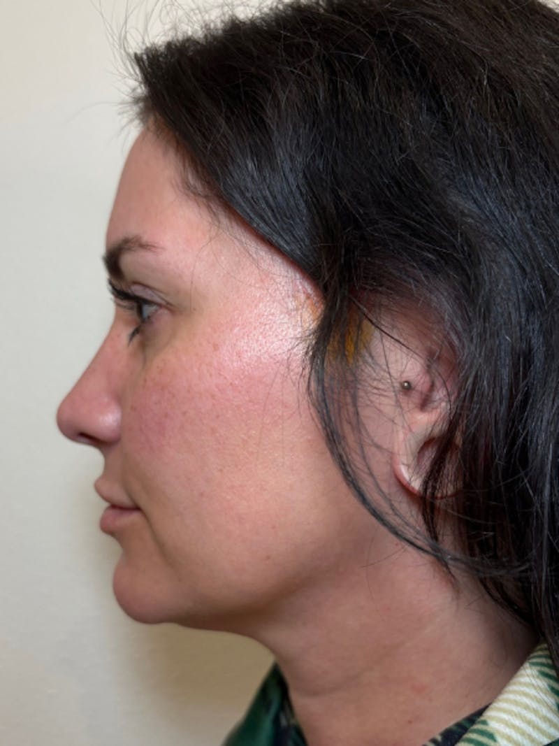 Everesse Before & After Gallery - Patient 485185 - Image 1