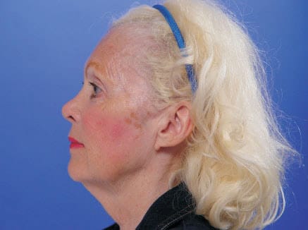 facelift patient