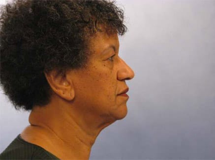 facelift patient