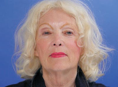 Facelift Before & After Gallery - Patient 383316 - Image 1