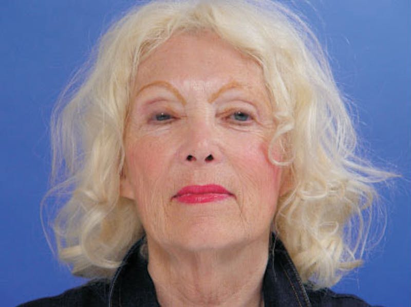 Facelift Before & After Gallery - Patient 383316 - Image 1