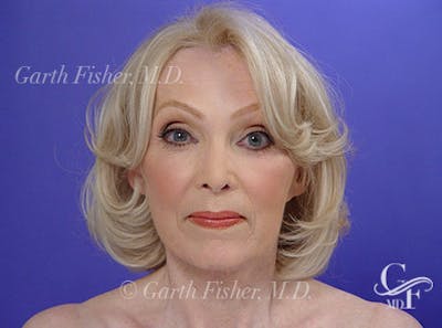 Facelift Before & After Gallery - Patient 383316 - Image 2