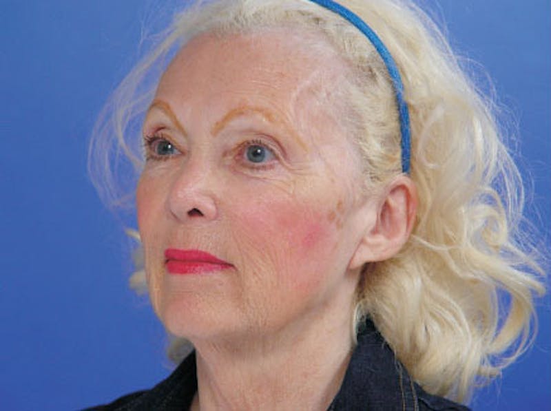 Facelift Before & After Gallery - Patient 383316 - Image 3