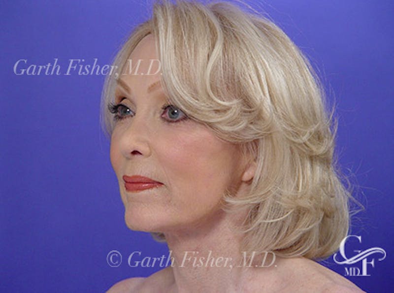 Facelift Before & After Gallery - Patient 383316 - Image 4