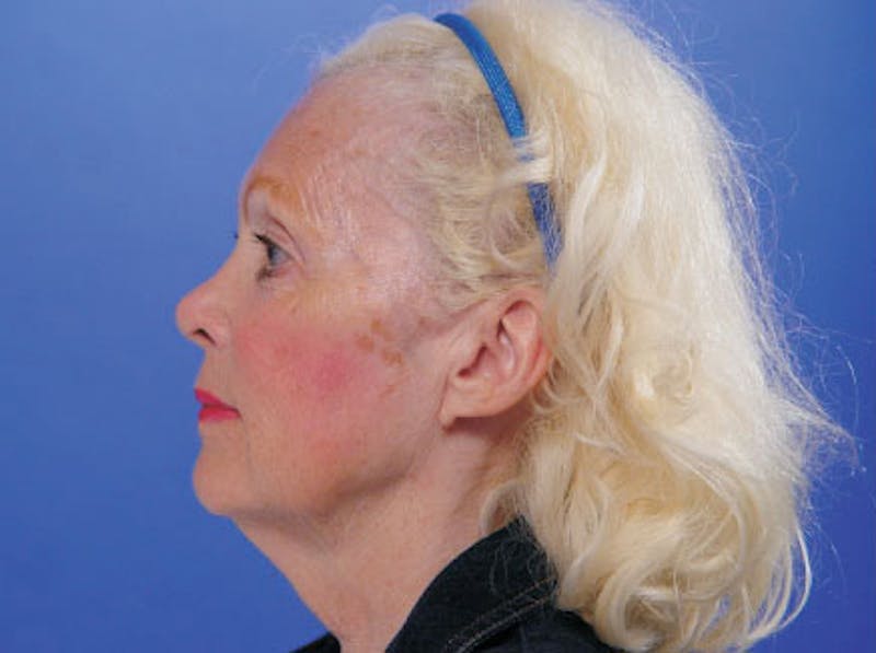 Facelift Before & After Gallery - Patient 383316 - Image 5