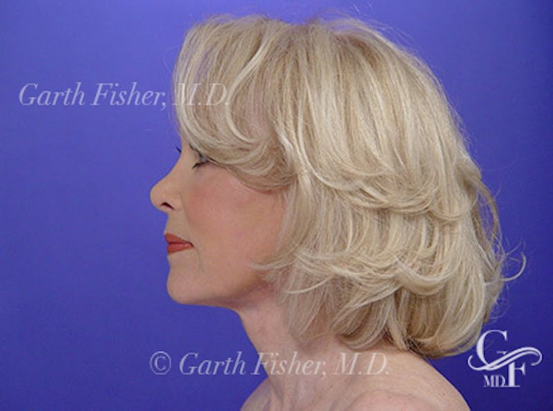 Facelift Before & After Gallery - Patient 383316 - Image 6