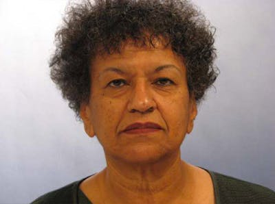 Facelift Before & After Gallery - Patient 461832 - Image 1