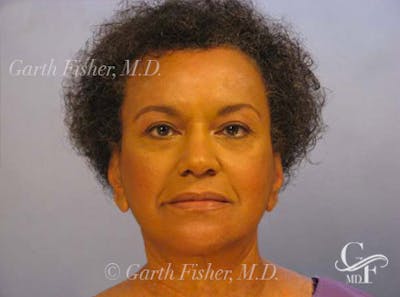 Facelift Before & After Gallery - Patient 461832 - Image 2